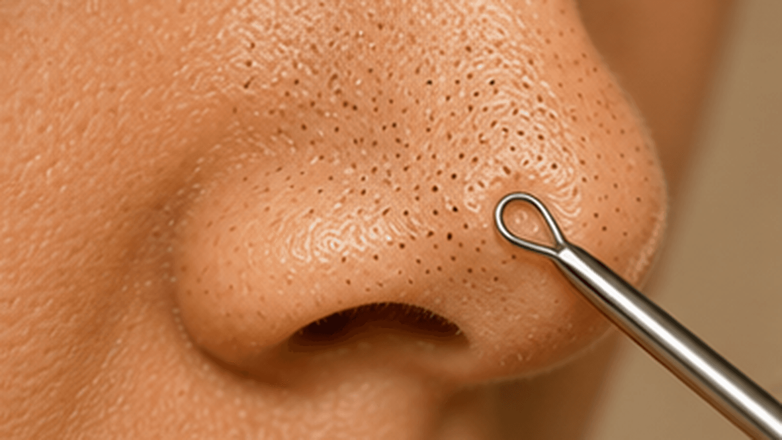 Close-up of blackheads on the nose